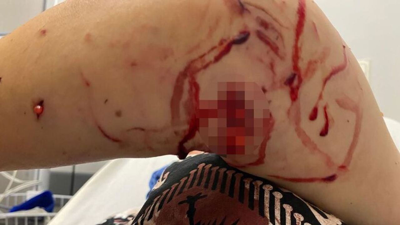 Kocaeli'de köpek saldırısına uğrayan kadın adeta parçalandı