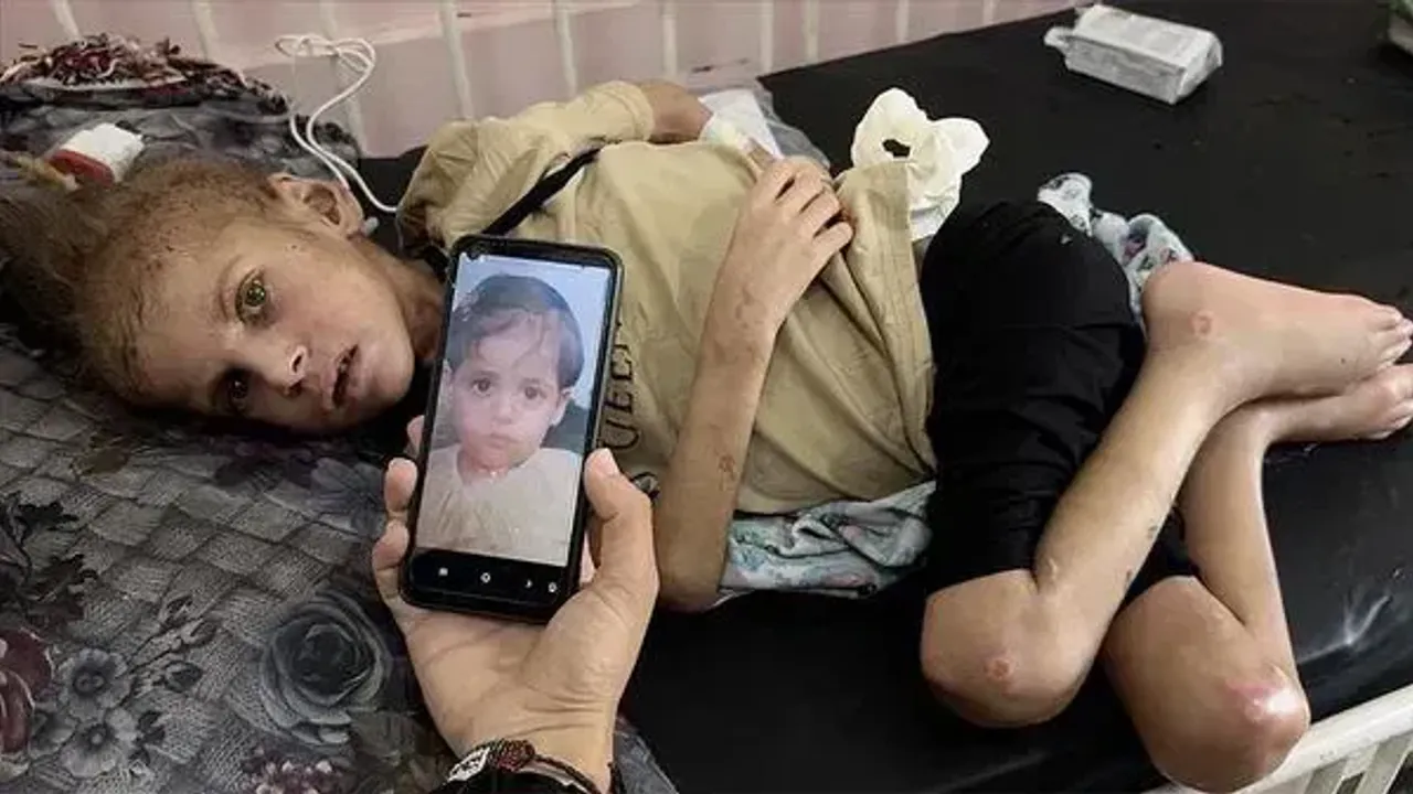 Yetersiz Beslenme Nedeniyle Yürüyemez Hale Geldi