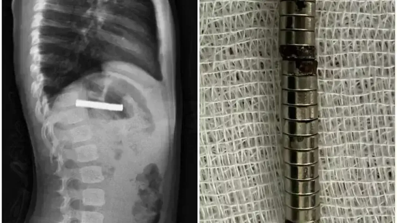 3 Yaşındaki Çocuğun Midesinden 19 Mıknatıs Çıkarıldı