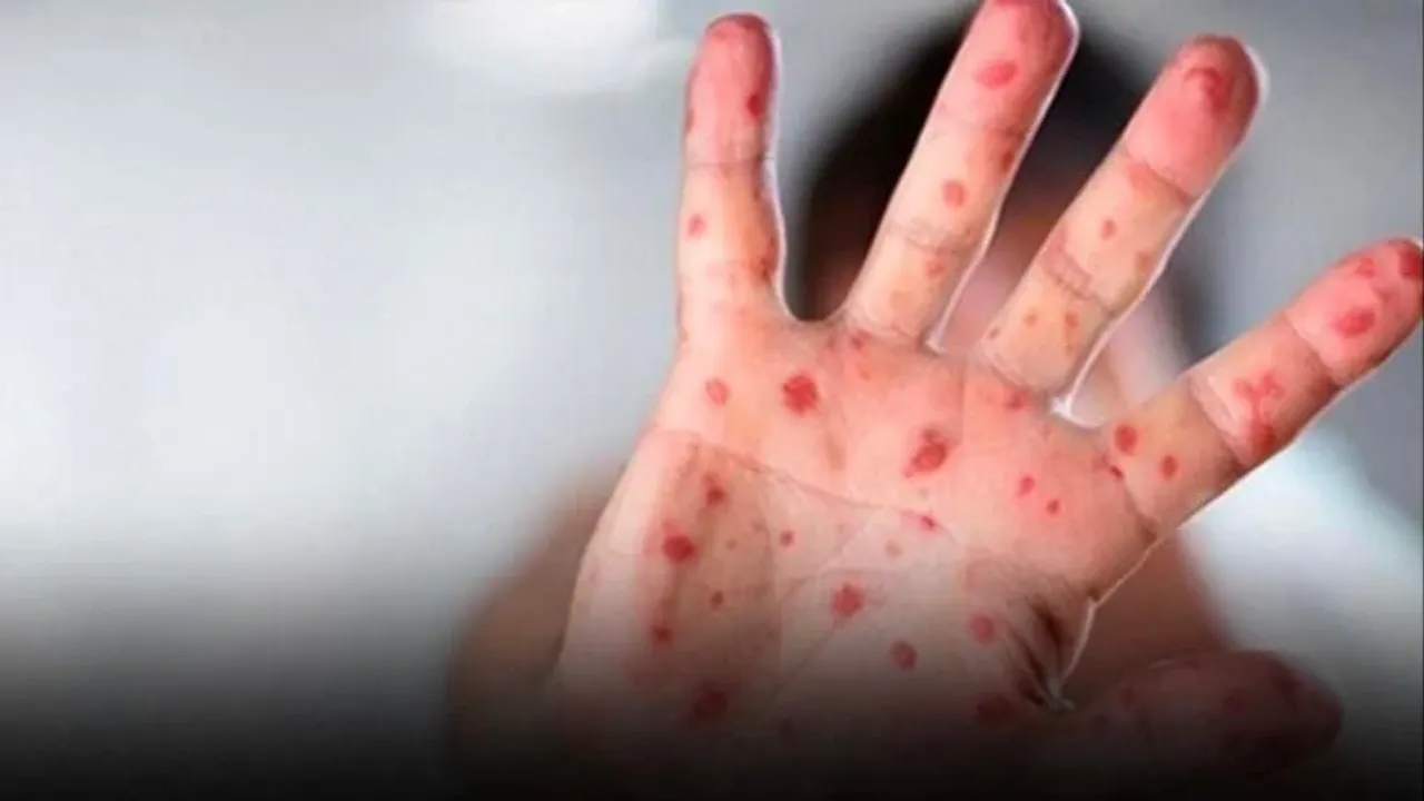 Yeni Virüs Tehlikesi Kapıda! Dünyayı Saran Salgın Hızla Yayılıyor