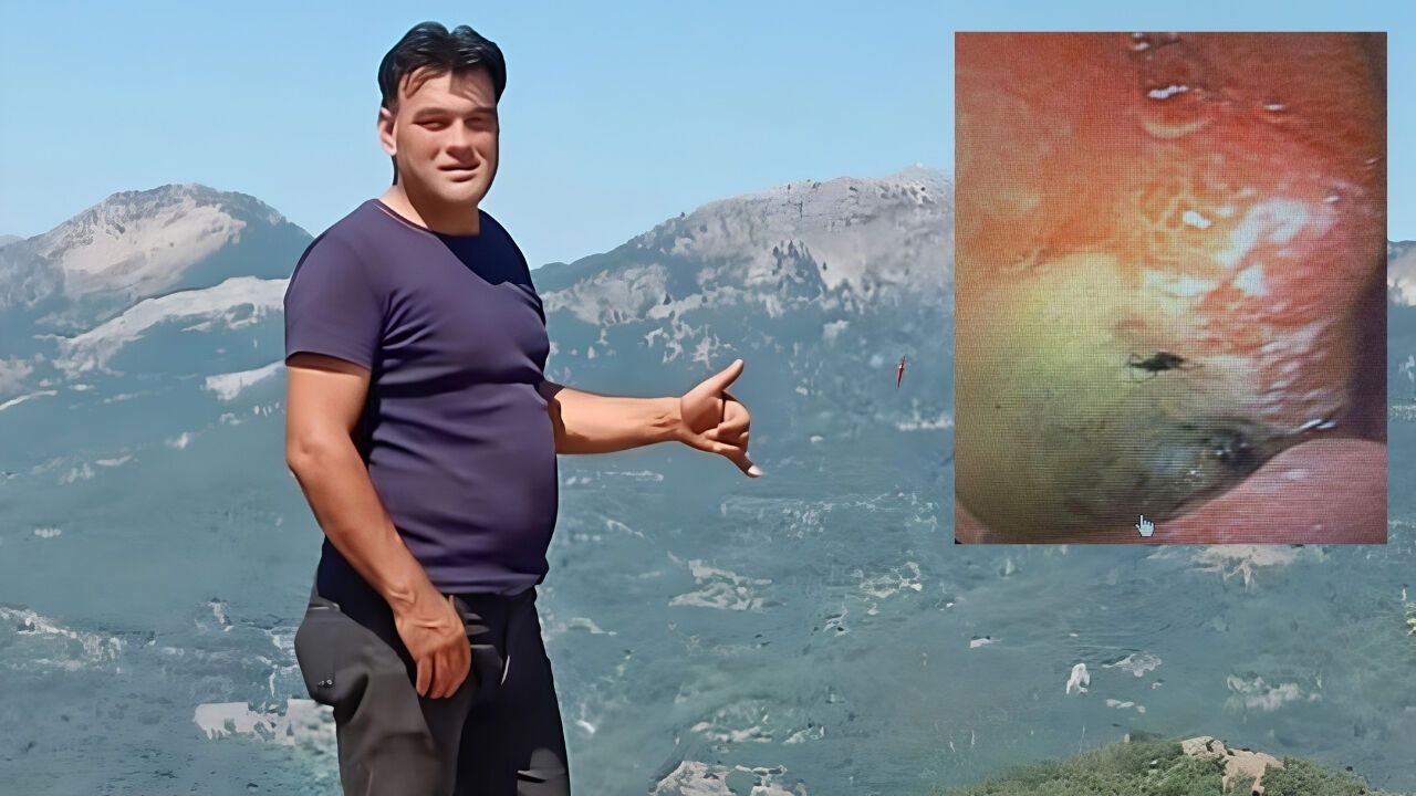 Midesinden Canlı Böcek Çıkarıldı