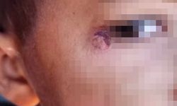 Öğrencinin yüzünde sigara söndürdü!