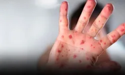 Yeni Virüs Tehlikesi Kapıda! Dünyayı Saran Salgın Hızla Yayılıyor