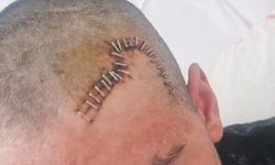 Okulda Kan Donduran Zorbalık: Taşla Vurdu, Kafatası Parçalandı