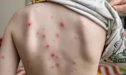 Eyvah! Okullarda Su Çiçeği Alarmı