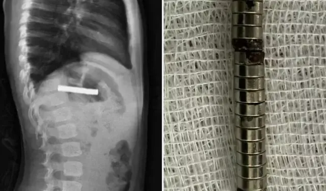 3 Yaşındaki Çocuğun Midesinden 19 Mıknatıs Çıkarıldı