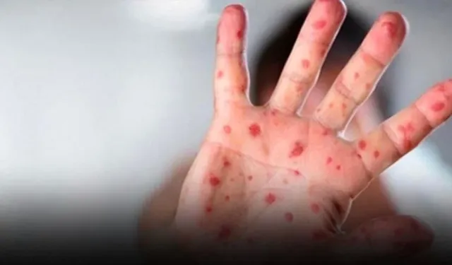 Yeni Virüs Tehlikesi Kapıda! Dünyayı Saran Salgın Hızla Yayılıyor