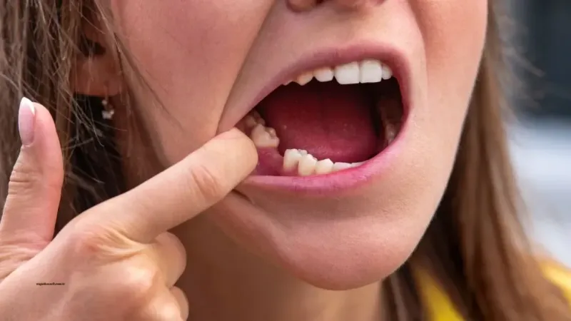 Rüyada Diş Dökülmesi Ne Anlama Gelir?