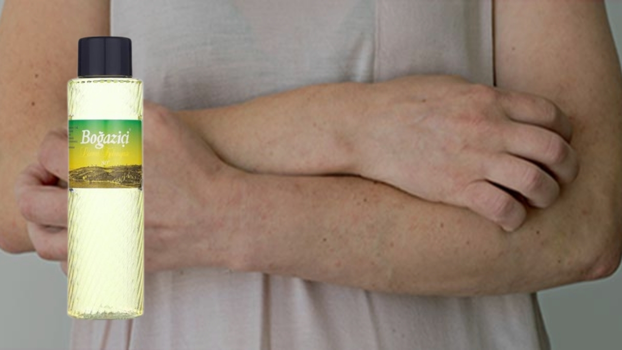 Kolonya Uyuz Bocegini Oldurur