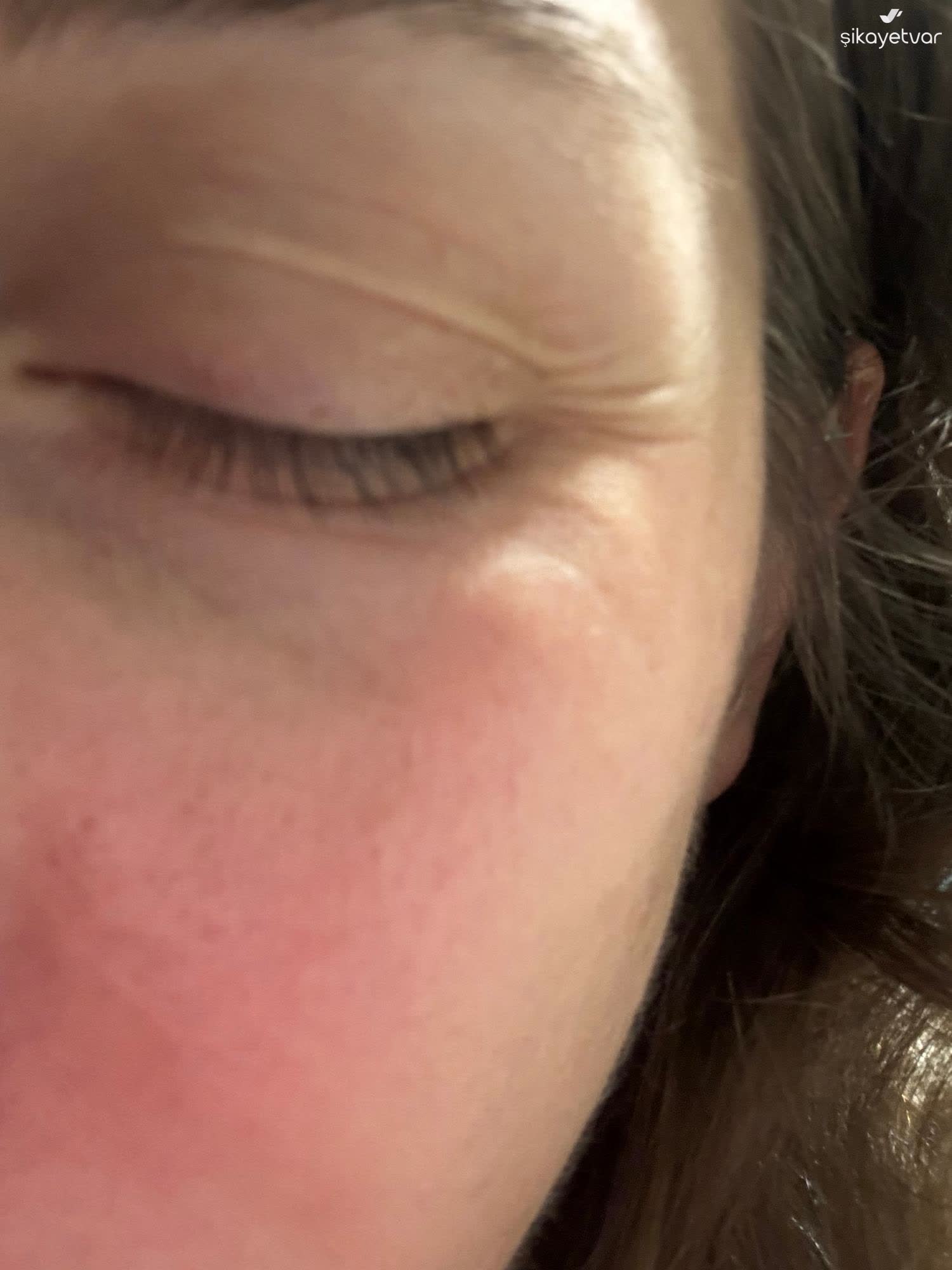 Nivea Jel Krem Cildimde Siddetli Yanma Ve Tahrise Sebep Oldu 1